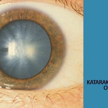 katarak bisa dicegah kaca film