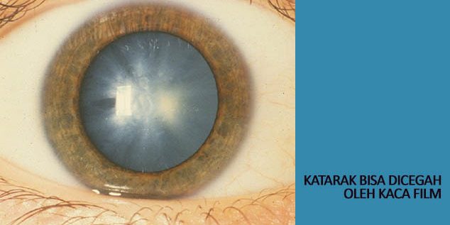 katarak bisa dicegah kaca film