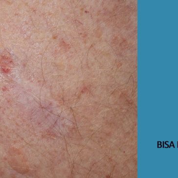 Kanker Kulit Bisa Dihalau Kaca Film