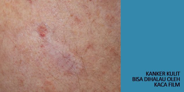 Kanker Kulit Bisa Dihalau Kaca Film