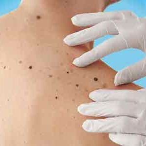 kanker-kulit,-sinar-ultra-violet